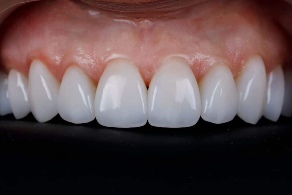 Dental Veneers Before and After Cosmetic Dentistry Dentist in Phoenix AZ at 7 North Dental
