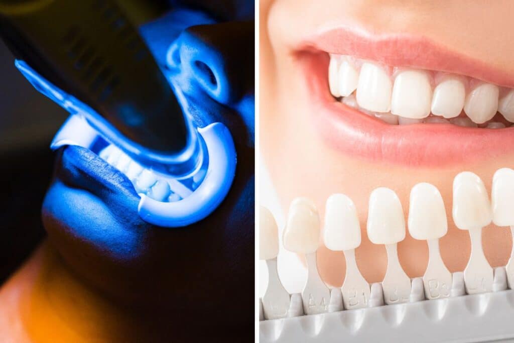 teeth whitening Before and After Cosmetic Dentistry Dentist in Phoenix AZ at 7 North Dental 
