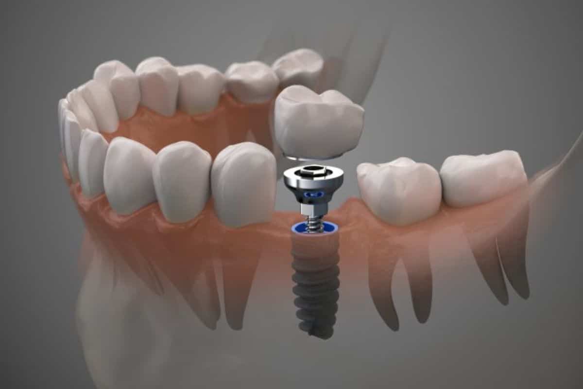 Dental Implants in Phoenix to restore your oral function